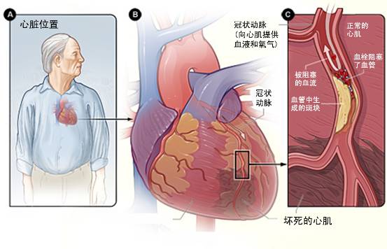 冠心病的起因是什么?(图1) 冠心病的起因是什么?(图1)
