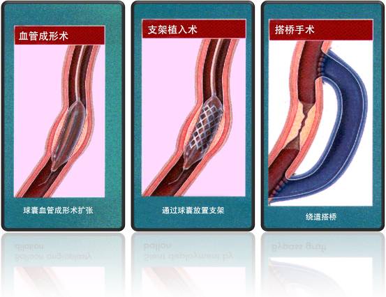 怎样治疗冠心病?(图1) 怎样治疗冠心病?(图1)