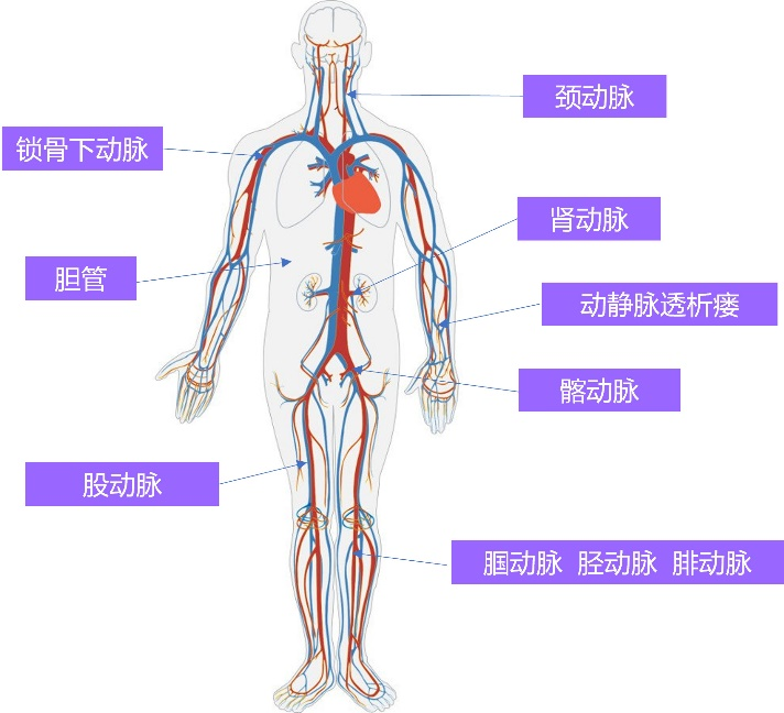 周游™ Voyaging™球囊扩张导管(图3) 周游™ Voyaging™球囊扩张导管(图3)